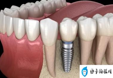 种牙整体费用有望降低50%,种植牙价格会越来越便宜吗