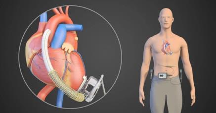 罗马尼亚5医生取死者人工心脏再用,人工心脏可以代替心脏吗