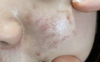 为什么洗完脸痘印会看起来很红 详解：痘印淡化过程痘印变化